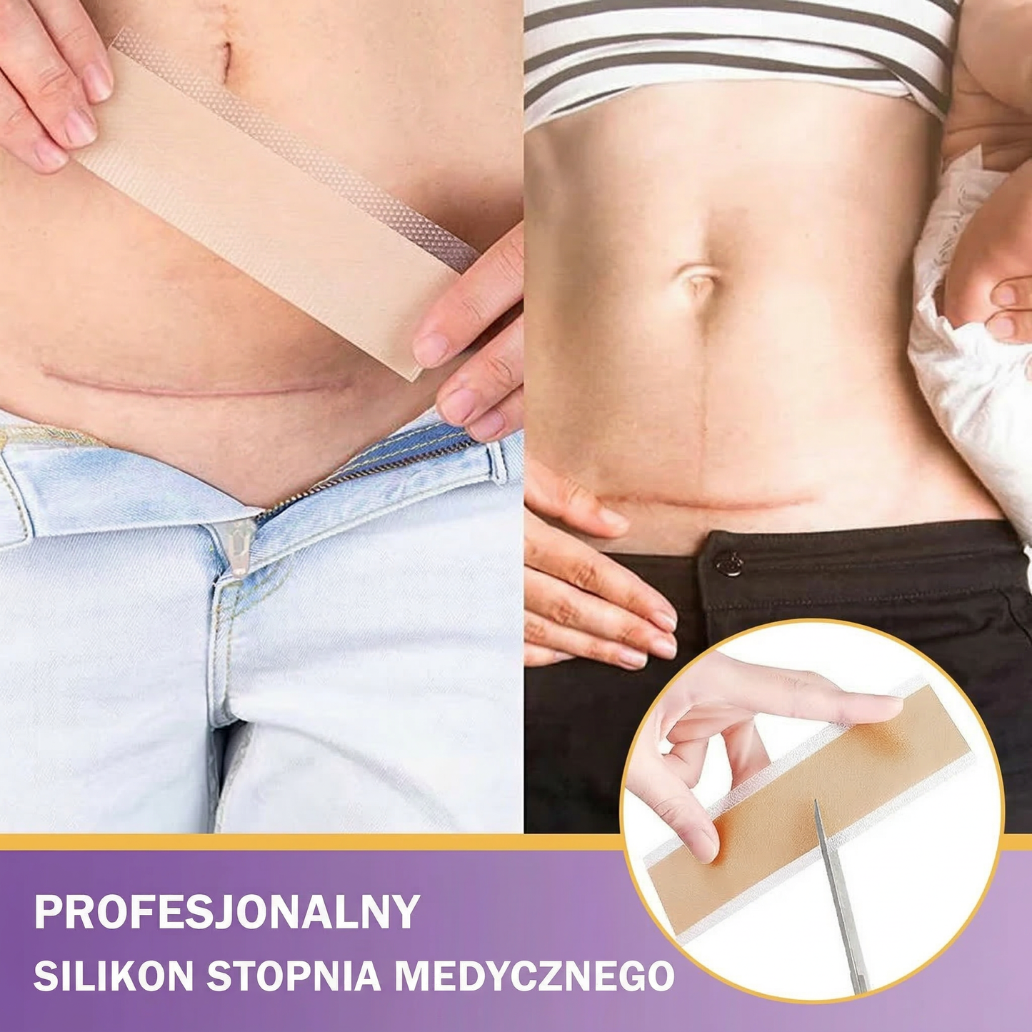 ✅Oficjalny sklep | BBOJI® kwas hialuronowy nano-mikroigłowa taśma naprawcza 🏥(leczenie starych i nowych blizn, redukcja blizn pooperacyjnych, rozstępów, bliznowców, trądziku, oparzeń, brodawek, zmian skórnych oraz żylaków)